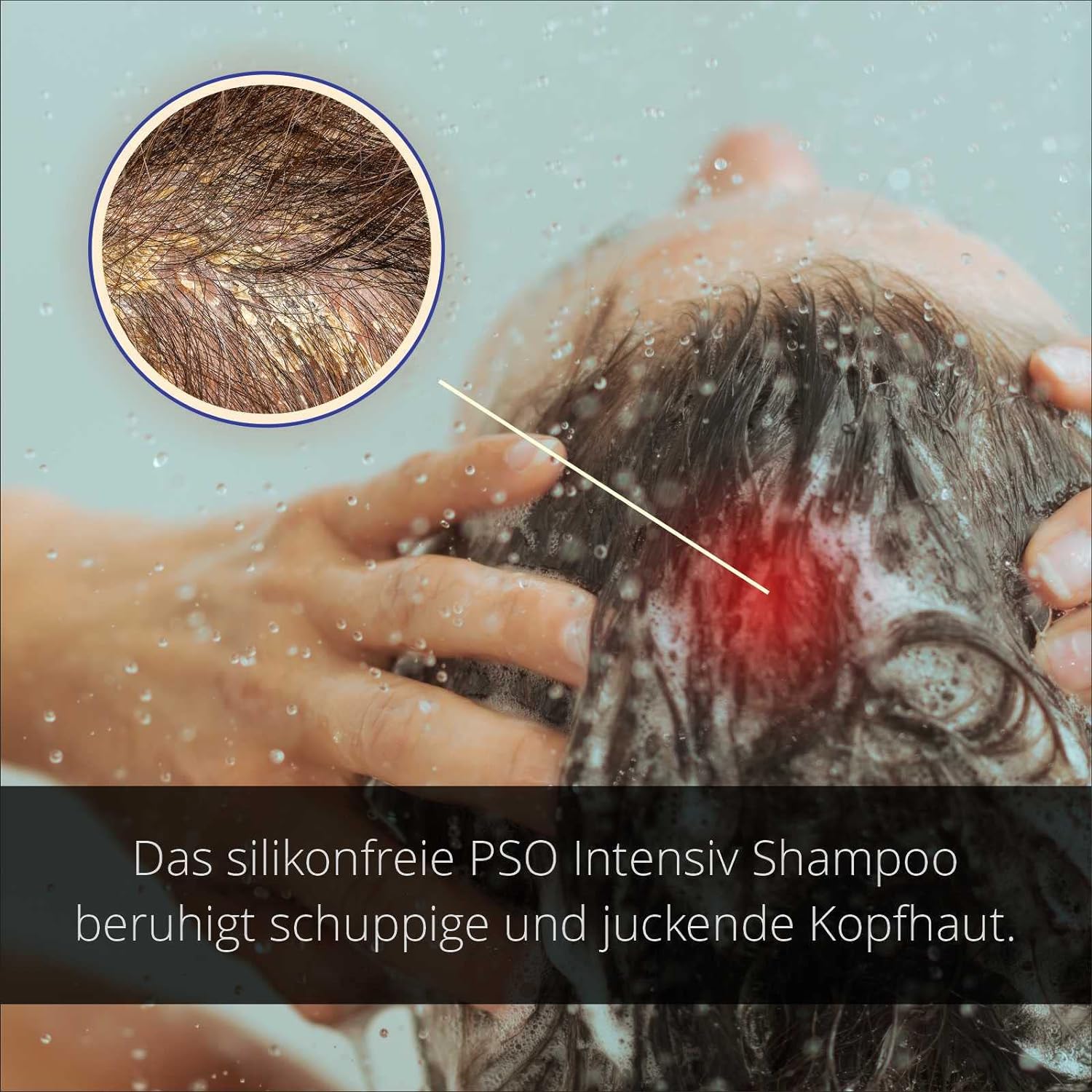 PSO Intensiv Shampoo - Spezialpflege bei Psoriasis